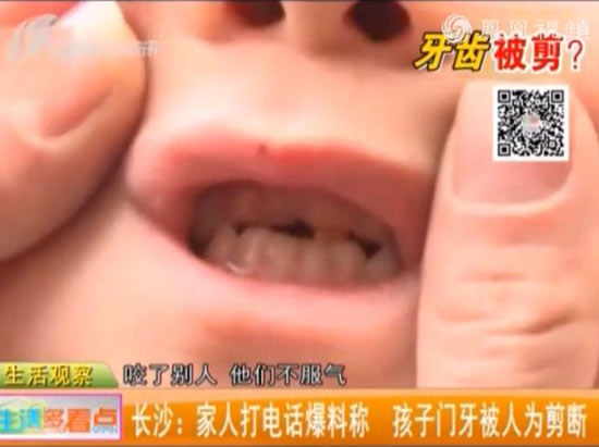 3岁男童咬伤幼儿园同学 遭对方奶奶剪掉4颗门牙