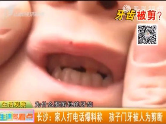 3岁男童咬伤幼儿园同学 遭对方奶奶剪掉4颗门牙