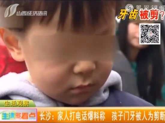 3岁男童咬伤幼儿园同学 遭对方奶奶剪掉4颗门牙