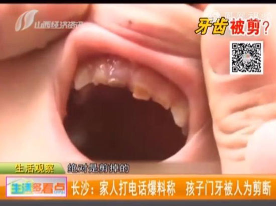 3岁男童咬伤幼儿园同学 遭对方奶奶剪掉4颗门牙