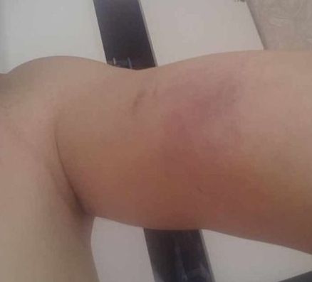 陈先生被同行殴打后,身上满是伤痕。