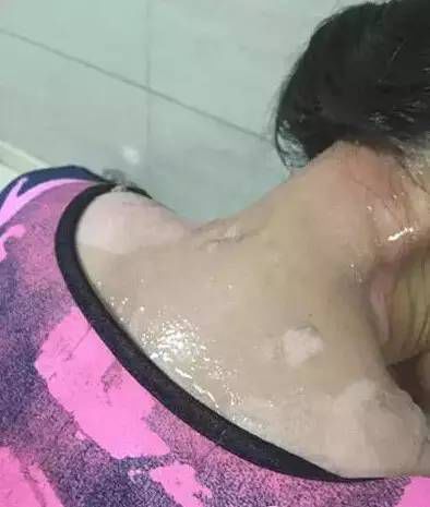 令人发指！火锅店服务员与女顾客起争执，竟将一锅滚汤浇在她头上！ 